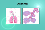 thumbs_Asthma